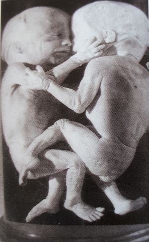 fig. 1 - Gemelli siamesi.jpg